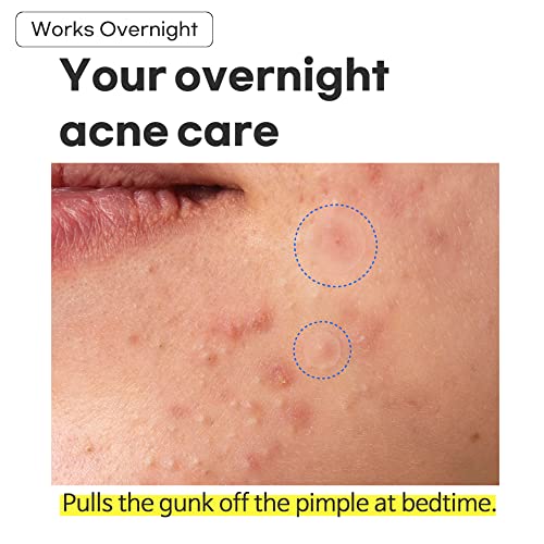 TIAM 96 Count Hydrocolloid Acne Pimple Patches Pack of 4 for Overnight Skin Care