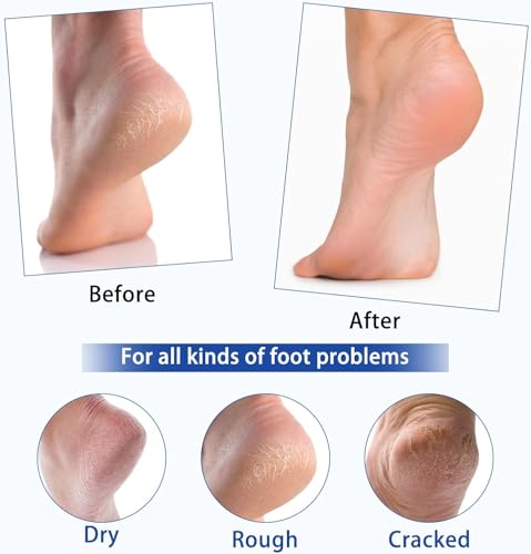 Dinalio 40% Urea Foot Care Cream for Dry, Cracked Heels - 5.29 fl. oz