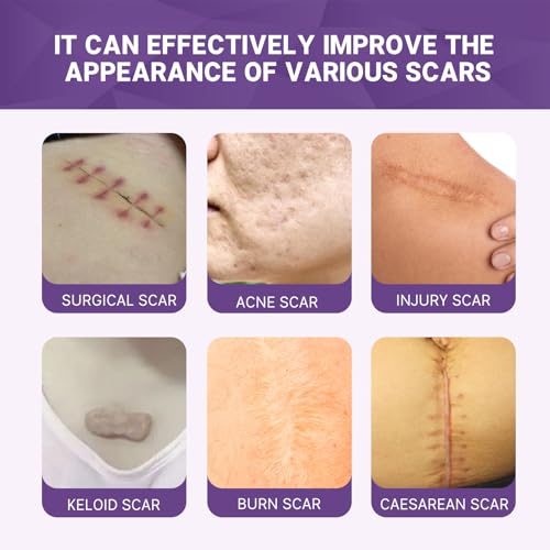 RCSCBC Scar Soothing Cream 1PCS - Advanced Silicone Scar Removal for Surgical, Acne, Burns, C-Section & Injury