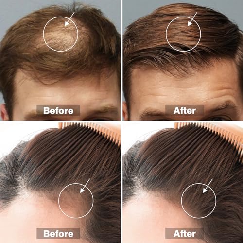Glemme 5% Minoxidil Hair Growth Serum with Biotin for Men & Women