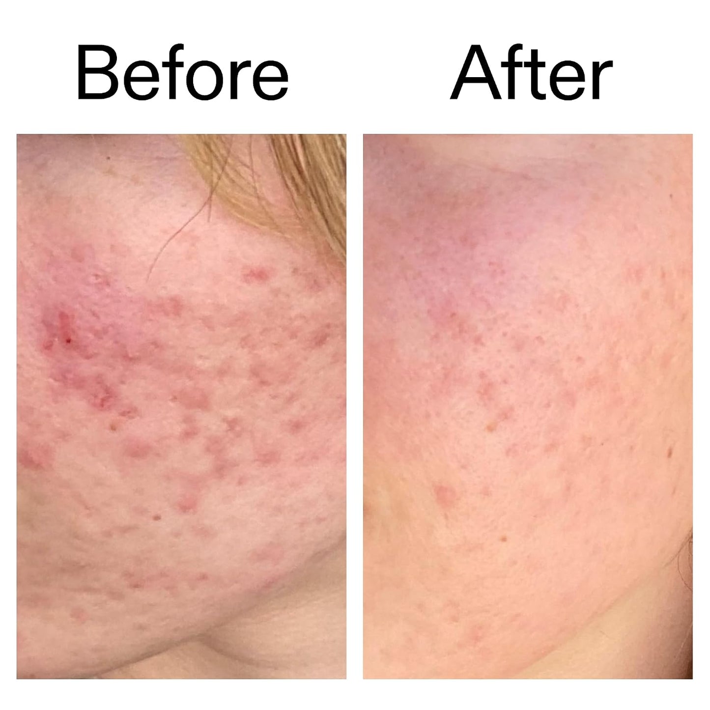 Azelaic Acid 10% Serum - Fast-Absorbing Formula to Reduce Redness & Sooth Skin | 1.01 fl oz