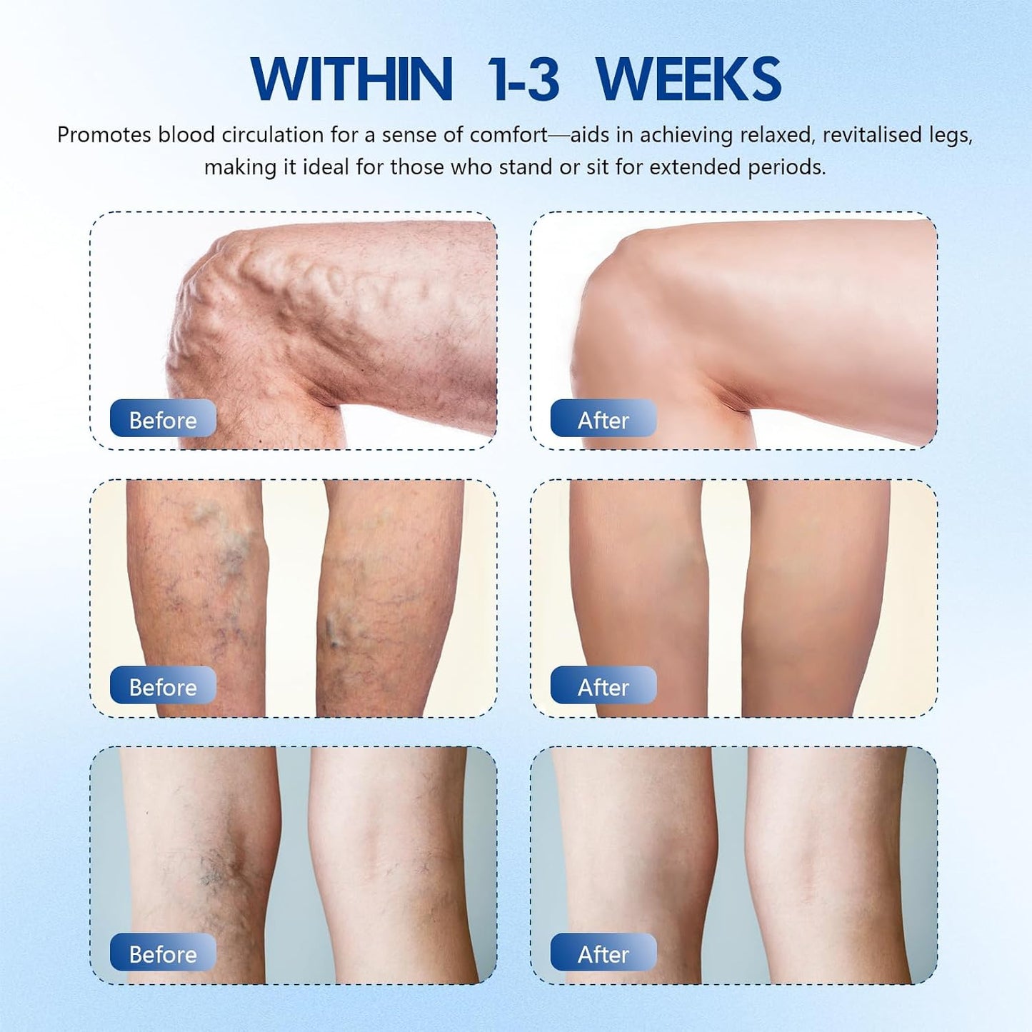 Vein Target Microdarts Patch - Professional Varicose Veins Treatment for Legs | Natural Ingredients, All Skin Types