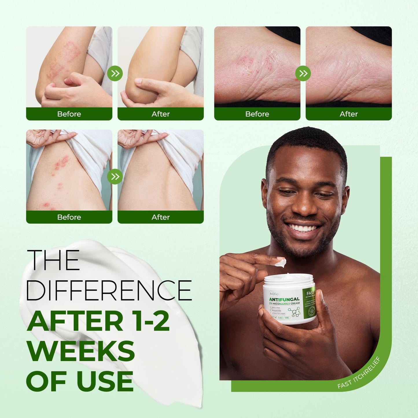 Inlifay 2% Miconazole Antifungal Cream: Helps relieve the itching, burning, cracking, and scaling associated with fungal infections such as athlete's foot,jock itch, and ringworm(3.52 OZ)