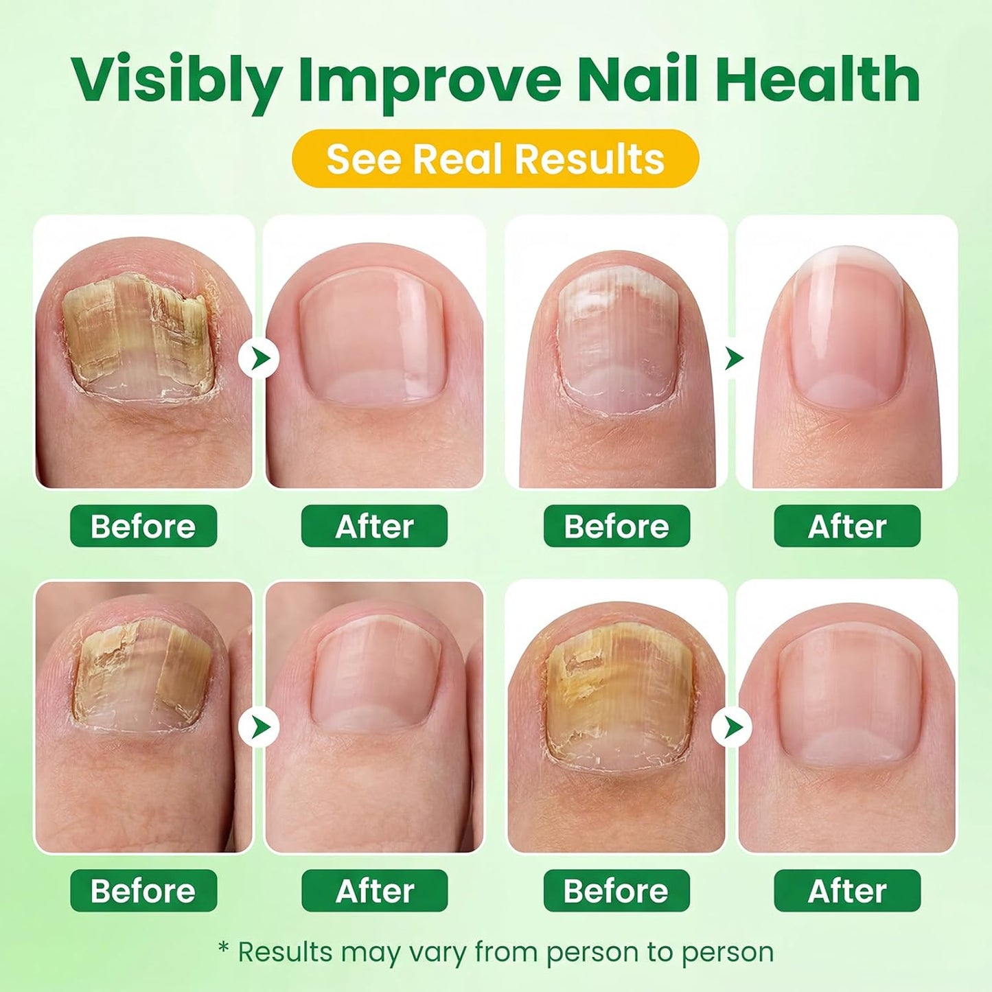 Nail Fungus Treatment Pen - 25% Undecylenic Acid Formula for Toenails & Fingernails | 16ml (3-Pack)