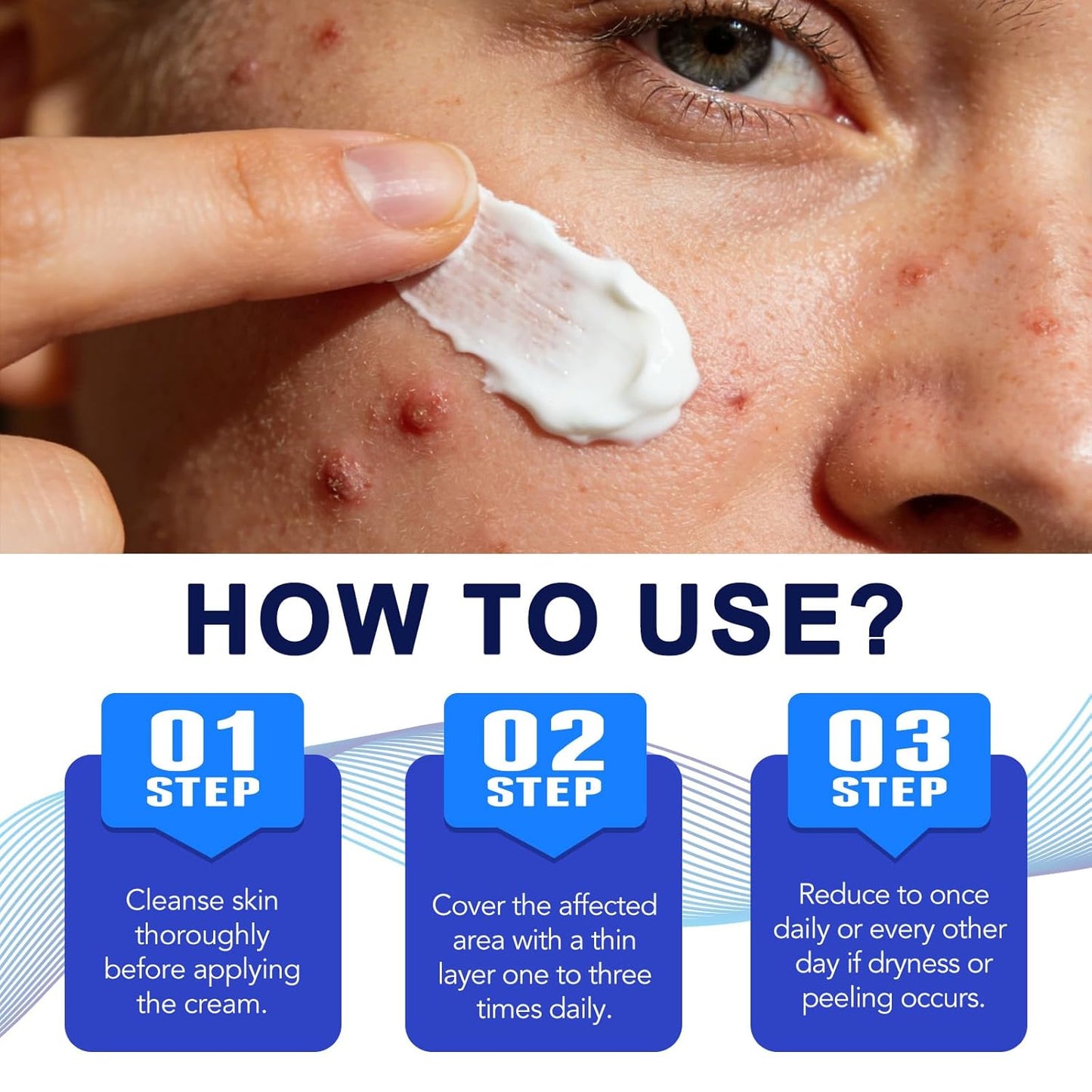Acne Cream for Face, Scalp & Body - 1% Salicylic Acid & Herbal Extracts | Pore Refining & Oil Balancing - 100g