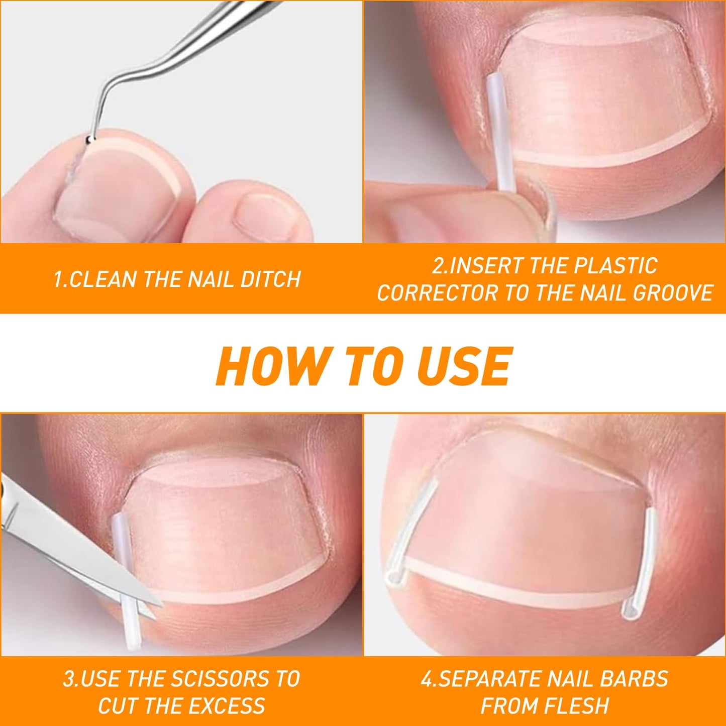 Ingrown Toenail Corrector Set, Ingrown Toenail Treatment Kit Including Correction Strips, Pedicure Tools & Breathable Patches - Professional Home Pedicure Care for Curved Toenails