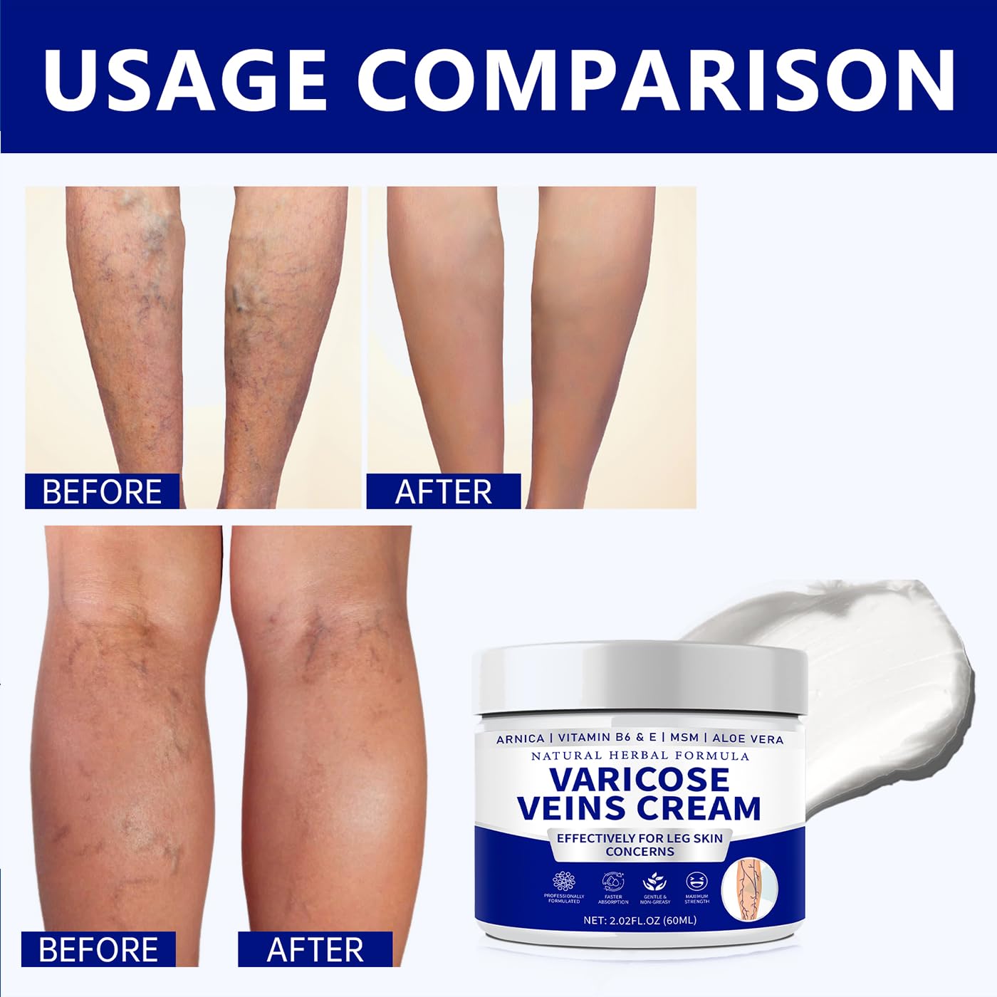 Varicose Veins Cream for Legs - Natural Spider Vein Treatment for Women & Men | Gentle Formula