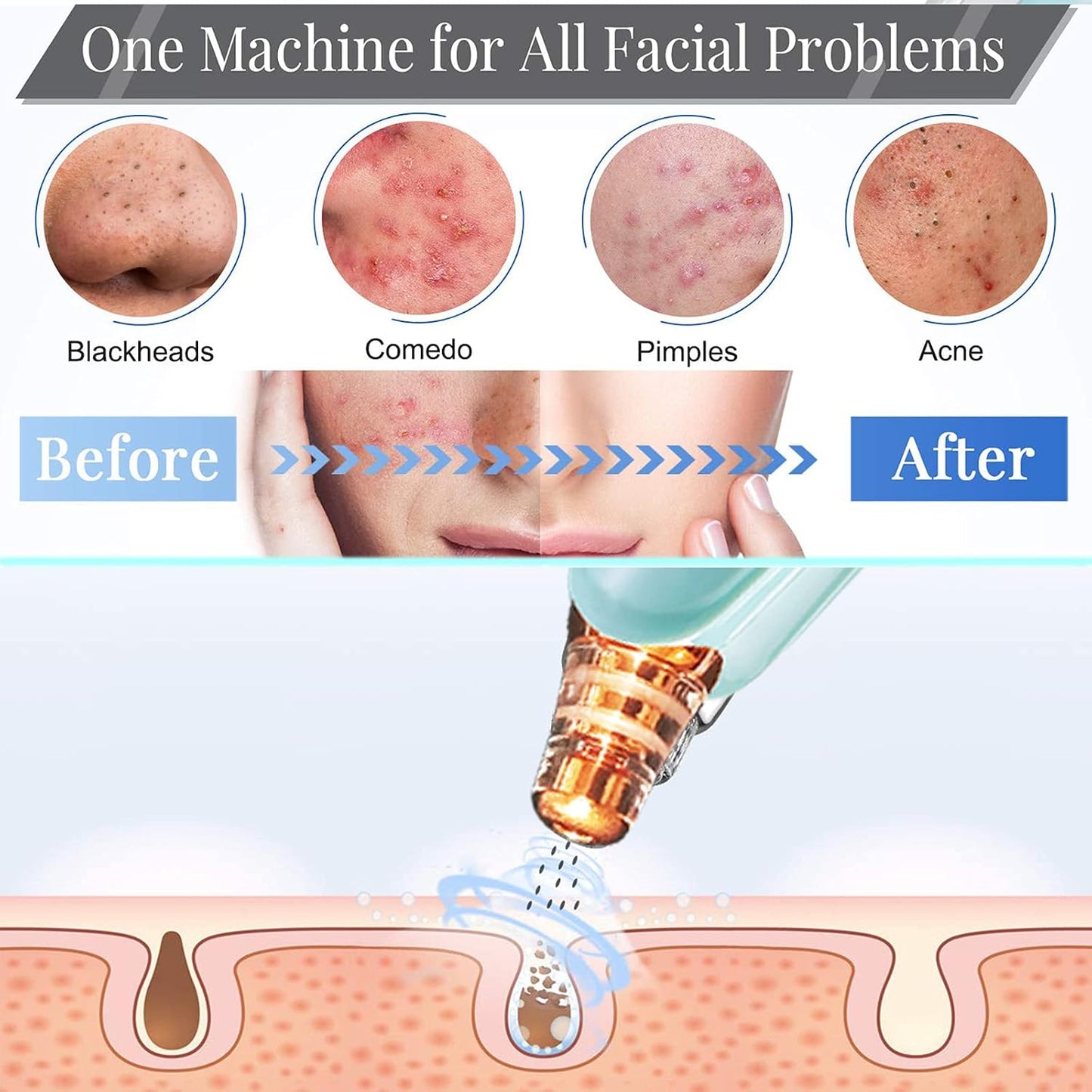Blackhead Remover Pore Vacuum - Electric Facial Cleaner with 5 Probes | USB Rechargeable Suction Tool