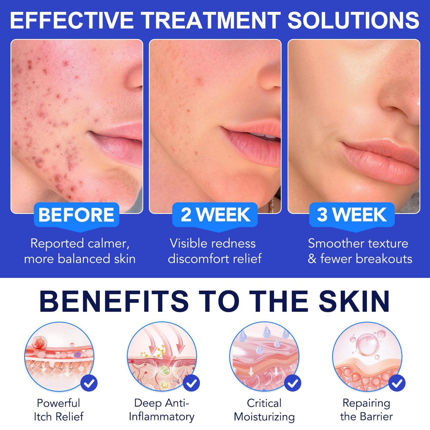 Cystic Acne & Folliculitis Care Cream for Face and Body - 1% Salicylic Acid & Multi-Acid Complex - Stubborn Spot Blemish, Pimple & Butt Breakout Clearing Control - Suitable for Sensitive Skin