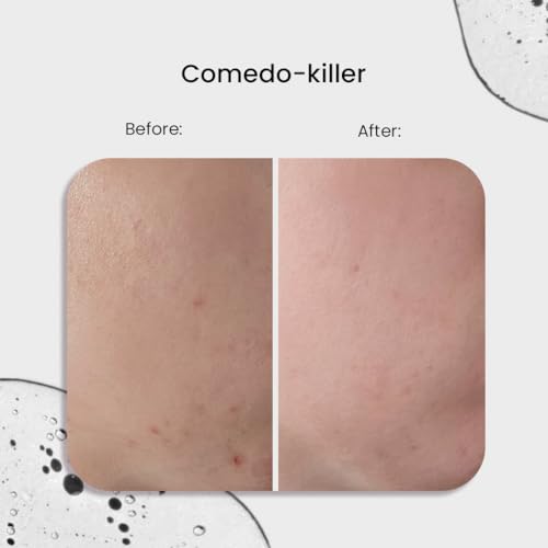 SkinTra Comedo-Killer 2% Salicylic Acid Acne Spot Treatment Serum for Oily Skin