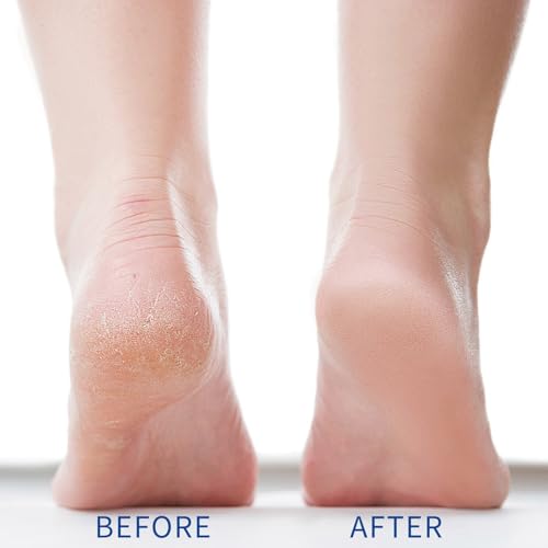 CABAOLY 40% Urea Cream for Dry Cracked Feet & Skin Repair