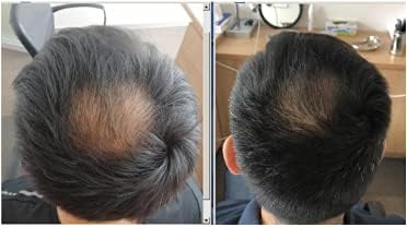 Hair Growth Serum | 7-Week Regrowth Kit with Biotin, Caffeine & Peptides for Thinning Hair - 5x5mL