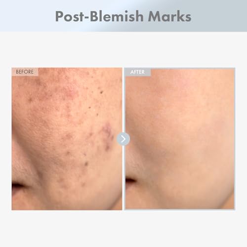 TOSOWOONG Niacinamide 15% Face Serum for Pore Minimizing & Dark Spots, 30ml