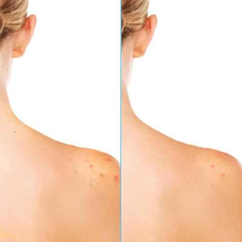 Differin Acne Body Spray - Salicylic & Glycolic Acid Treatment for Back & Chest, 6oz