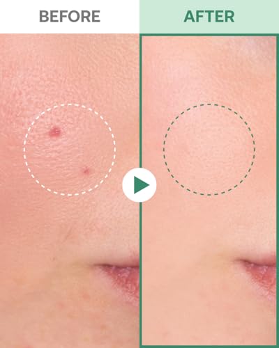 FILFLO Yangyang Pine Calming Spot Patch - Invisible Acne Treatment (12 Pack)