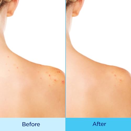 Differin Acne Body Spray - Salicylic & Glycolic Acid Treatment for Back & Chest, 6oz