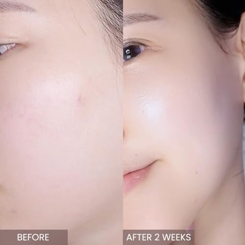 Aplin Pink Tea Tree Serum with Hyaluronic Acid & Niacinamide - Hydrating Korean Skin Care, 30mL