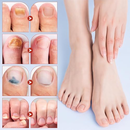 KOSIMI Extra Strength Toenail Repair Patches - 8-Hour Overnight Treatment