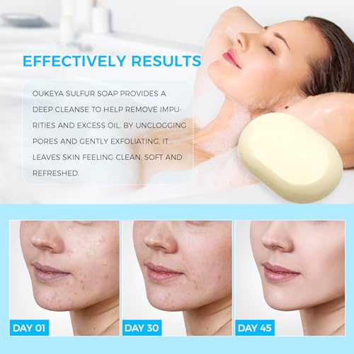 OUKEYA Sulfur Soap for Face with 10% Sulfur & 2% Salicylic Acid - 4.05 oz (Pack of 2)