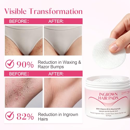 Ingrown Hair Treatment Pads for Face: Prevent Ingrown Hairs with BHA + AHA Soothe Razor Bumps for Bikini Area Underarms Neck Legs After Shave & Waxing Treatment - 50 Pads