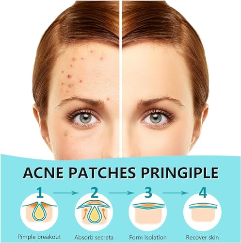 Invisible Hydrocolloid Pimple Patches for Acne Treatment - 360 Count