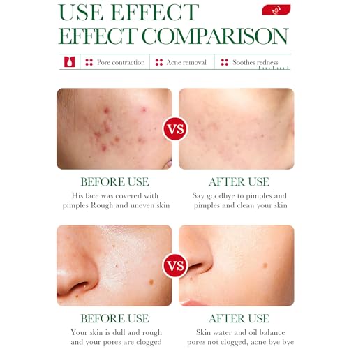 BIOAQUA Salicylic Acid Acne Removal Essence - 35ml