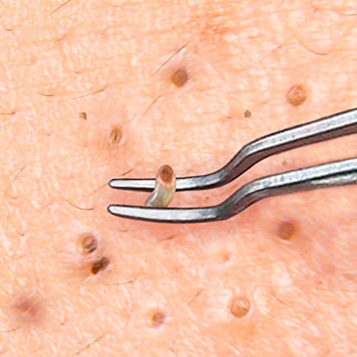 Beaute Galleria Stainless Steel Curved Blemish Extractor Tool