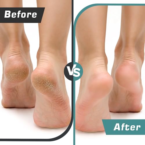 EDIFOLLY Electric Foot Callus Remover - Professional Pedicure Tool, Black