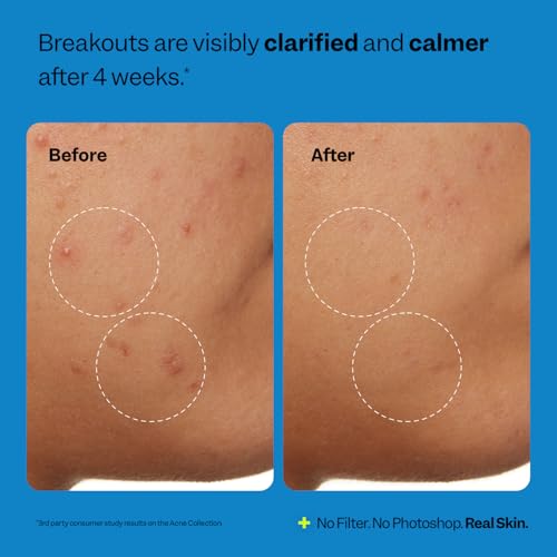 Peach Slices Acne Clarifying Cleanser - 2% Salicylic Acid, Vegan
