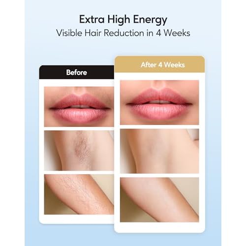 INNZA IPL Hair Removal with Ice Cooling Care Function for Women and Men,Long-Lasting Results, Painless Hair Removal, Hair Removal Device for Full Body