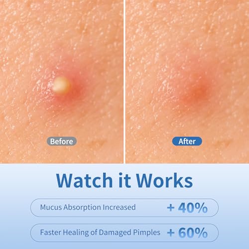 Daolyo Star Pimple Patches - 280 Hydrocolloid Acne Stickers