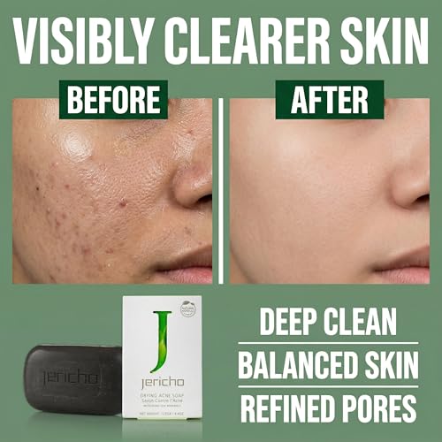 Jericho Acne Drying Bar Soap Pack of 1 - Dead Sea Mineral Facial & Body Cleanser for Oily Skin, Teens & Adults
