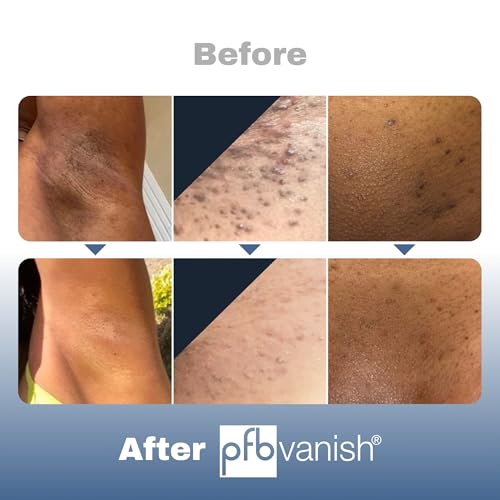 PFB Vanish Chromabright Razor Bump Stopper (3.28 oz) ? After Shave Soothing Solution, Razor Burn & Ingrown Hair Treatment, Relieve & Softens Skin, Dark Spots Remover for Face, Body & Intimate Areas
