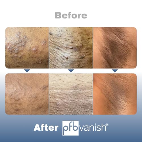 PFB Vanish Ultra Chromabright (3.28 oz) Triple Action Dark Spot Remover ? After Shave Smoothing Solution Ingrown Hair Treatment, Moisturizes, Relieves & Softens Skin, Razor Bump Stopper ? NEW Formula