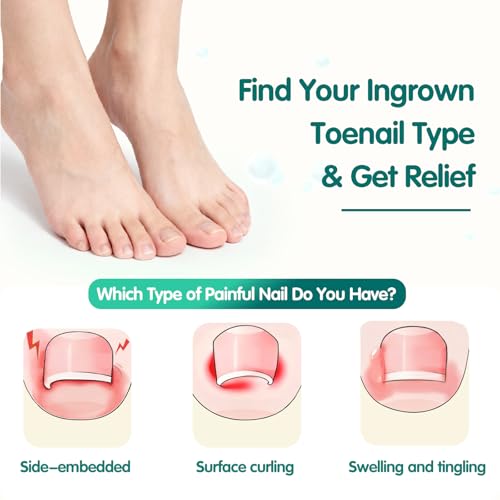 Ingrown Toenail Treatment Strips - 60 Count Breathable Toenail Corrector