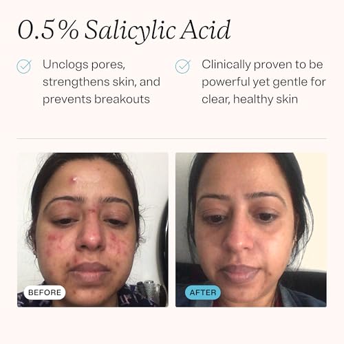 MDacne Hydrating Facial Cleanser 2 oz | 0.5% Salicylic Acid for Acne
