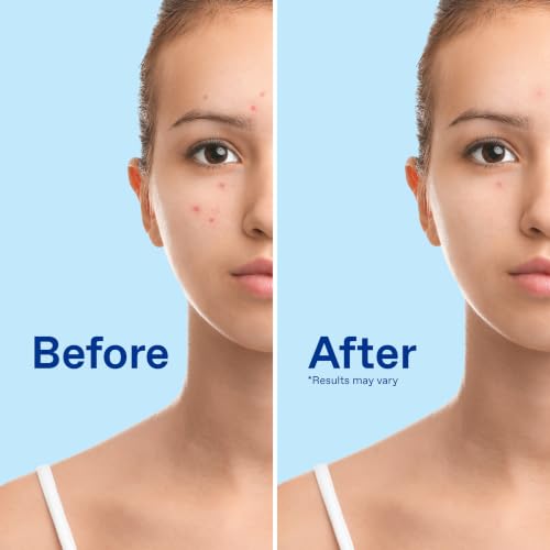 Differin Maximum Strength Acne Face Wash with 10% Benzoyl Peroxide, 5 oz
