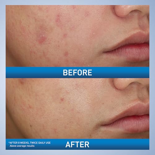 CeraVe Acne Foaming Face & Body Wash with Benzoyl Peroxide 10%, 5oz
