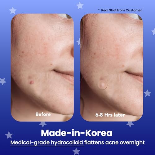 AVARELLE Hydrocolloid Acne Pimple Patches Nighttime 96 Count - Clear Spot Treatment