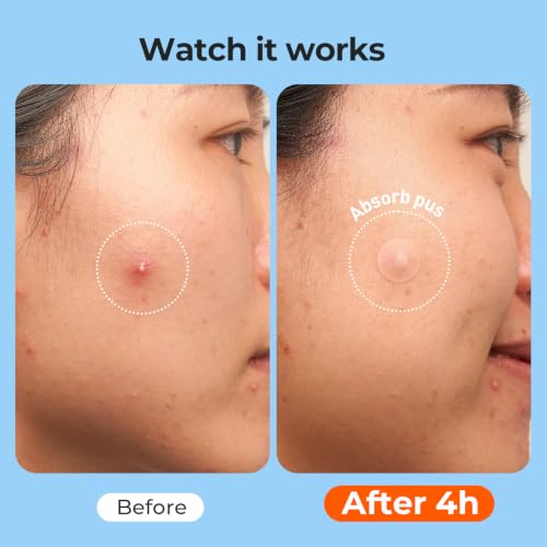 TKTK Hydrocolloid Pimple Patches - 609 Count Variety Pack for Acne Treatment