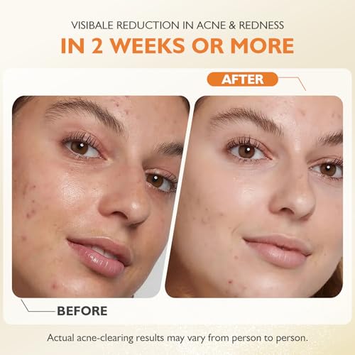 Natural Acne Treatment Balm for Face & Body – Hydrating, Non-Comedogenic Formula