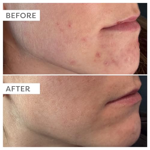 TruSkin Vitamin C Serum with Hyaluronic Acid - 1 Fl Oz