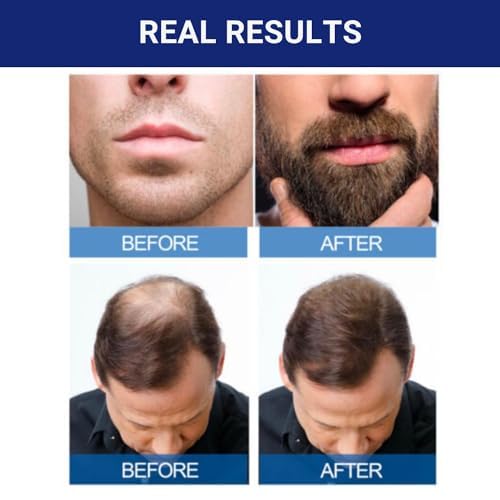 Kirkland Minoxidil 5% Hair Regrowth Solution for Men, 1-Month Supply