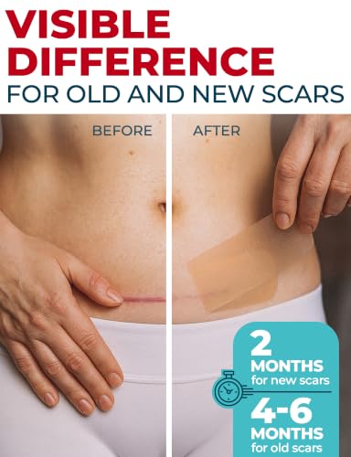 Medical Silicone Scar Sheets - 6 Reusable Strips for C-Section & Keloid Scars