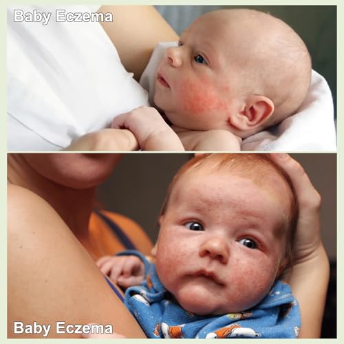 AOAO Heat Rash Care Cream for Babies, 100ml - Soothes Skin & Prevents Rashes