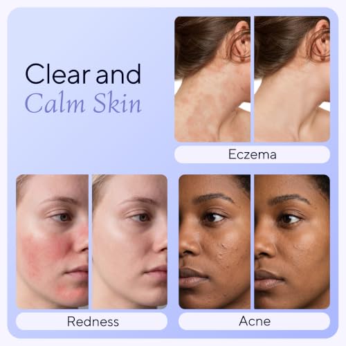 SAFOLYTE Hypochlorous Acid Face & Skin Spray 4oz - Gentle, Dermatologist Tested, Multi-Use for Acne, Eczema, Wounds
