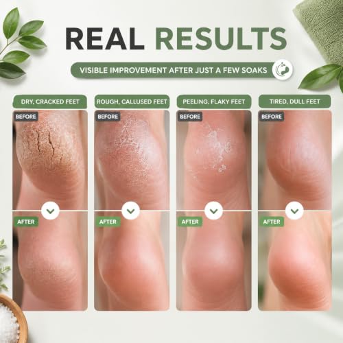 Tea Tree Oil Foot Soak - Epsom Salt Bath for Tired Feet, 16 oz