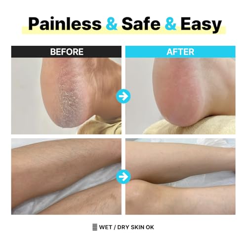 Mymi BlueBlue Dual Foot Callus & Hair Remover Nano Glass Device - Painless, Wet & Dry Use