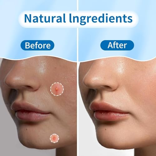 180 Count Hydrocolloid Acne Patches with Tea Tree Oil