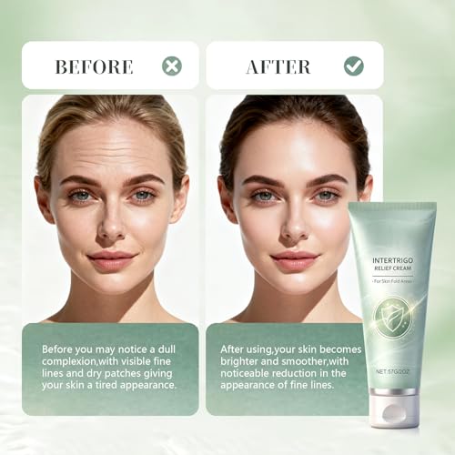 Intertrigo Relief Cream for Skin Folds - 1PCS | Zinc Oxide & Undecylenic Acid